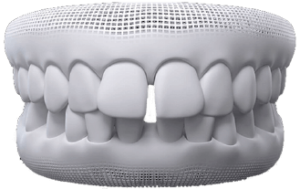 Diastema