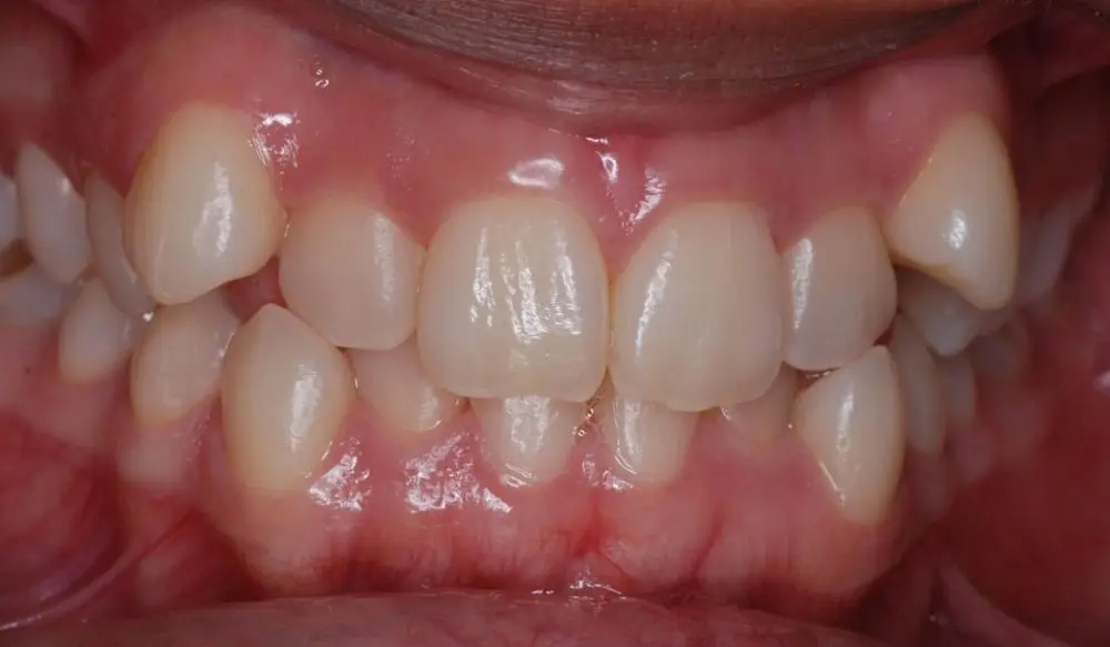 Antes do tratamento Invisalign