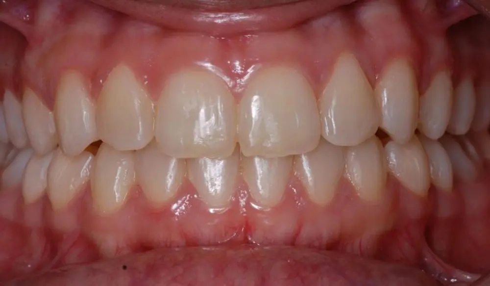 Depois do tratamento Invisalign